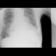 Upside-down stomach: X-ray - Plain radiograph
